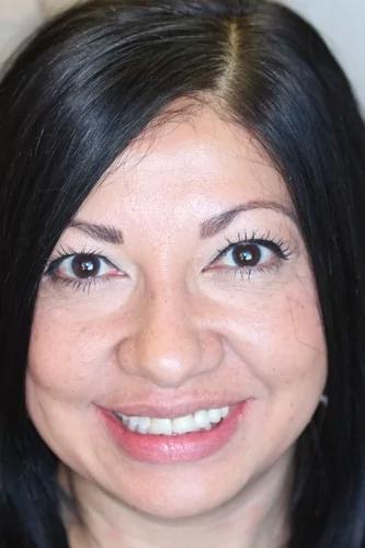 Dental Veneers before at Almeida & Bell Dental in Denver, CO