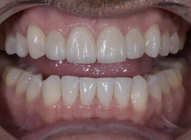 Teeth Whitening after at Luminous Smiles in Newport Beach, CA