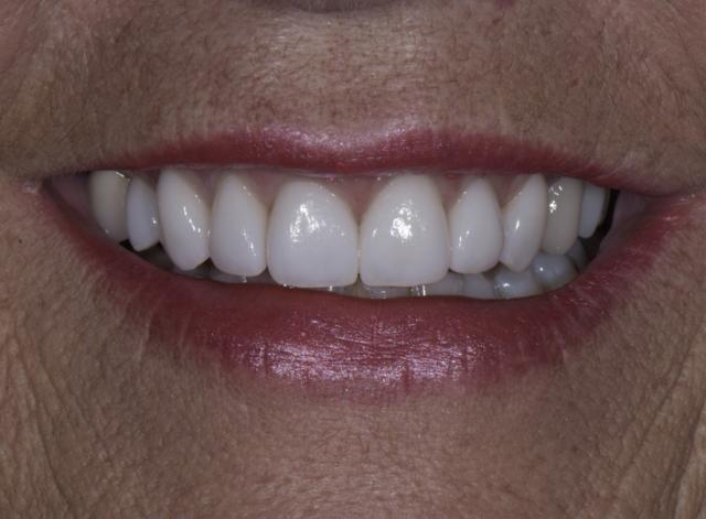 Dental Crowns after at Luminous Smiles in Newport Beach, CA