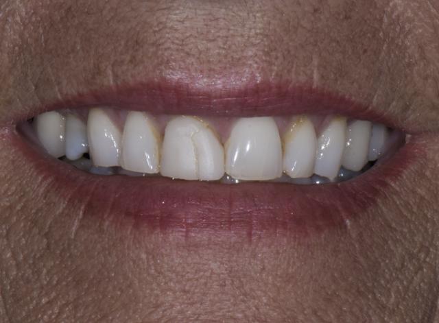 Dental Crowns before at Luminous Smiles in Newport Beach, CA