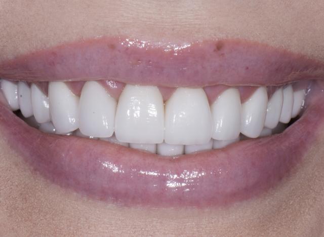 Teeth Whitening after at Luminous Smiles in Newport Beach, CA