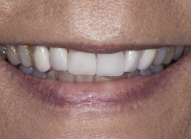 Teeth Whitening before at Luminous Smiles in Newport Beach, CA