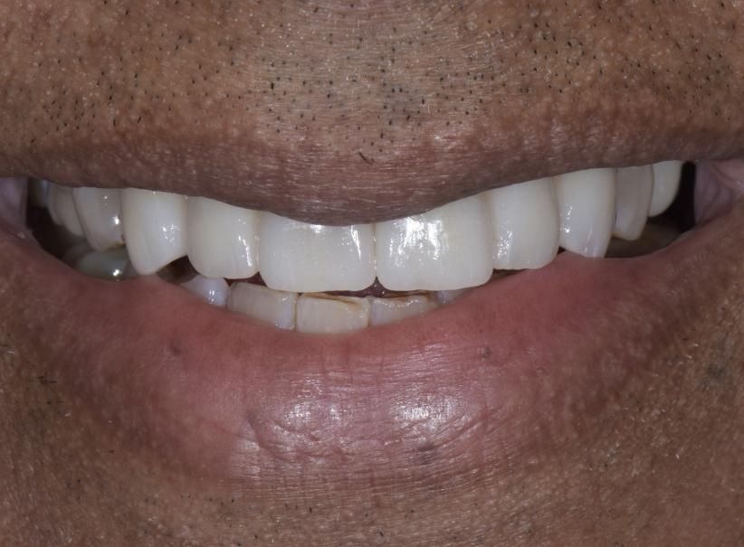 Luminous Smiles dental crowns after — Newport Beach, CA