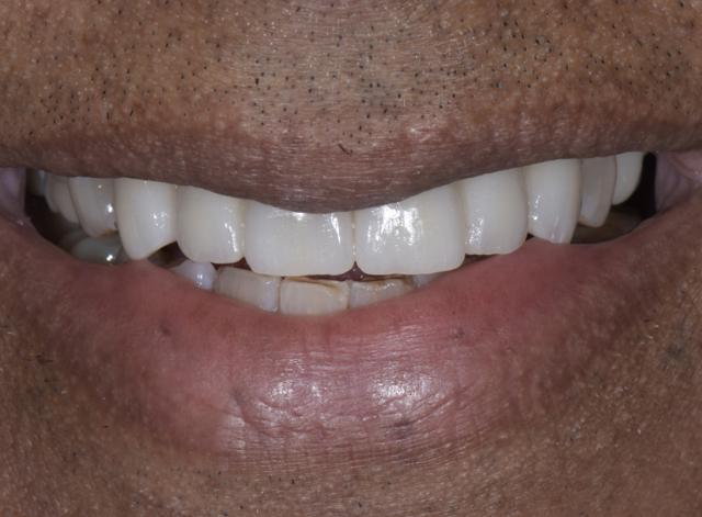 Dental Crowns after at Luminous Smiles in Newport Beach, CA
