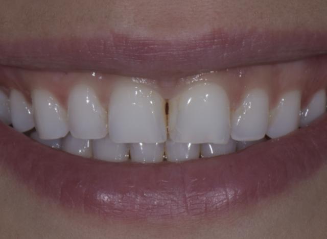 Teeth Whitening before at Luminous Smiles in Newport Beach, CA