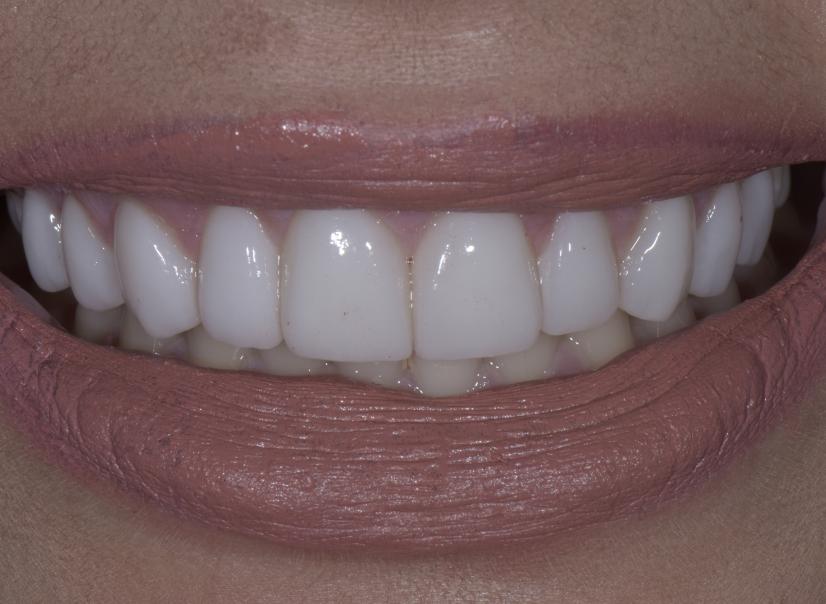 Luminous Smiles veneers after — Newport Beach, CA