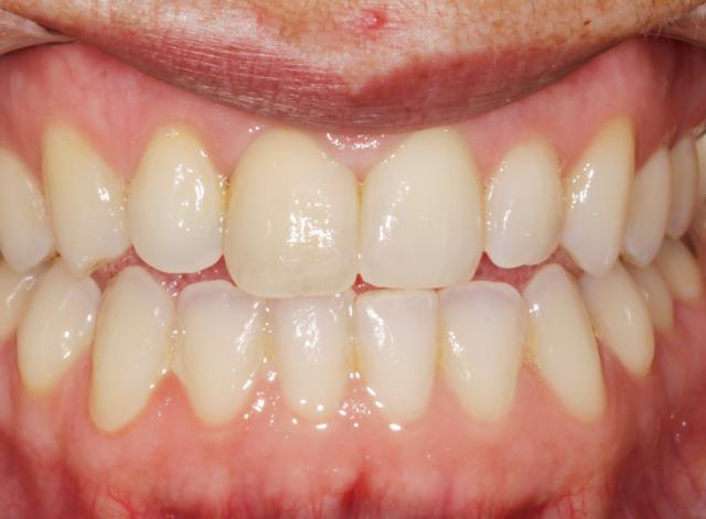 Teeth Whitening before at Luminous Smiles in Newport Beach, CA