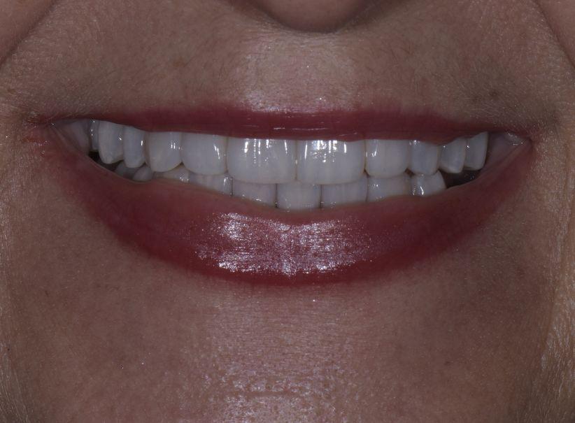 Luminous Smiles teeth whitening after — Newport Beach, CA