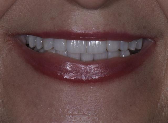 Teeth Whitening after at Luminous Smiles in Newport Beach, CA