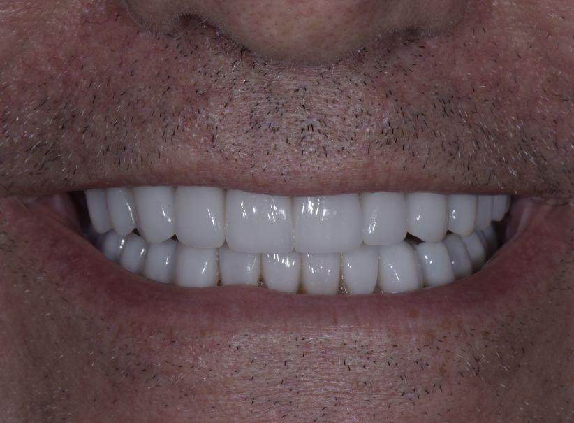 Luminous Smiles smile makeover after — Newport Beach, CA