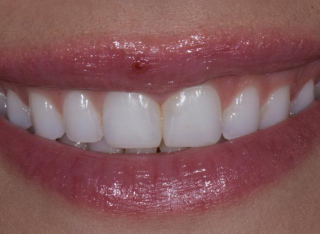 Teeth Whitening after at Luminous Smiles in Newport Beach, CA