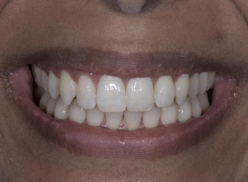 Luminous Smiles teeth whitening after — Newport Beach, CA