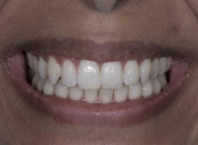 Teeth Whitening after at Luminous Smiles in Newport Beach, CA