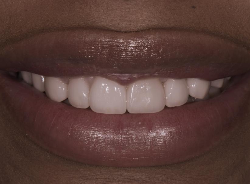 Luminous Smiles teeth whitening after — Newport Beach, CA
