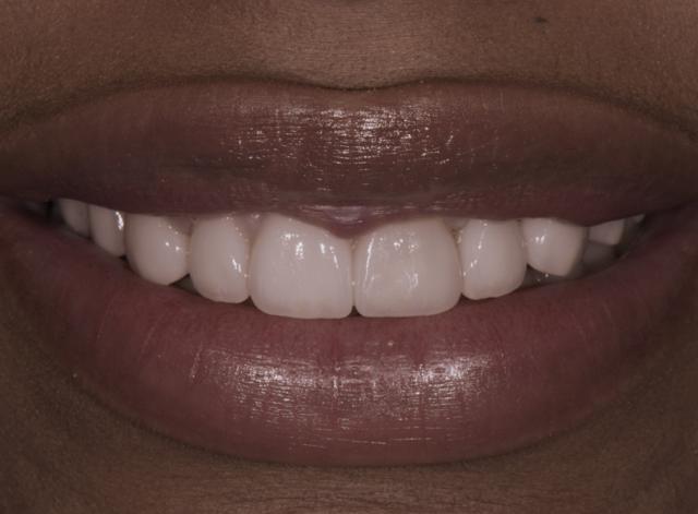 Teeth Whitening after at Luminous Smiles in Newport Beach, CA