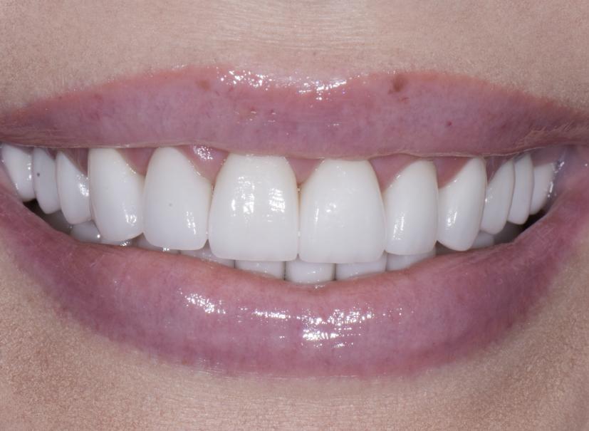 Luminous Smiles veneers after — Newport Beach, CA