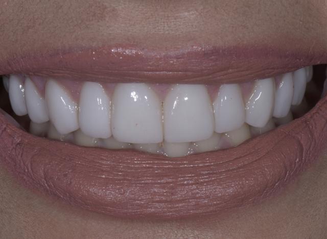 Teeth Whitening after at Luminous Smiles in Newport Beach, CA