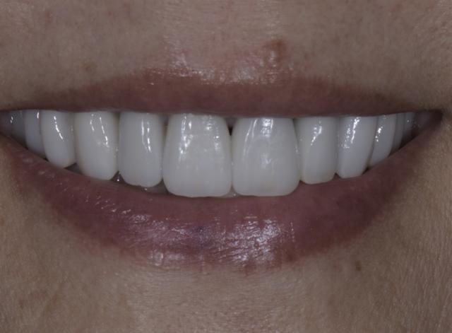 Dental Crowns after at Luminous Smiles in Newport Beach, CA