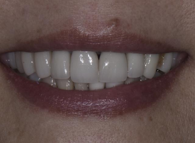 Dental Crowns before at Luminous Smiles in Newport Beach, CA