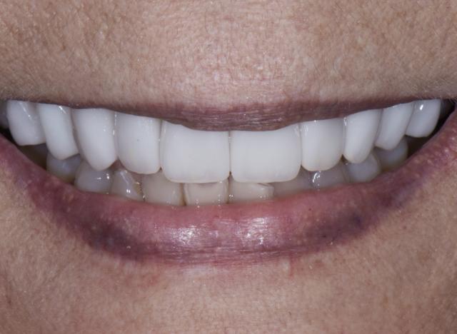Teeth Whitening after at Luminous Smiles in Newport Beach, CA