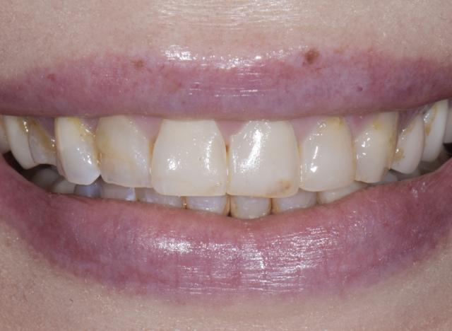 Teeth Whitening before at Luminous Smiles in Newport Beach, CA