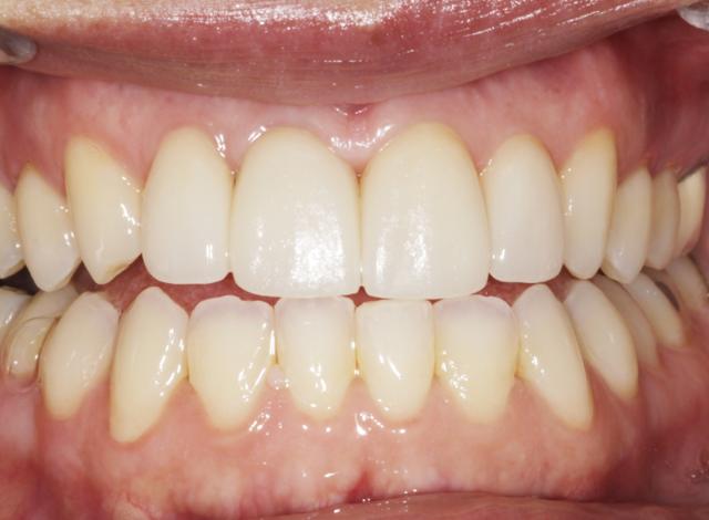 Teeth Whitening after at Luminous Smiles in Newport Beach, CA