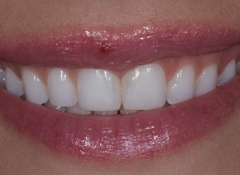Luminous Smiles smile makeover after — Newport Beach, CA