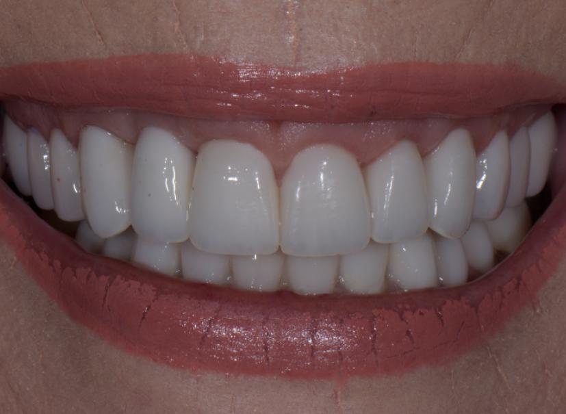 Luminous Smiles gum reshaping after — Newport Beach, CA