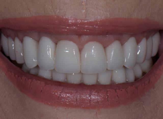Gum Contouring after at Luminous Smiles in Newport Beach, CA