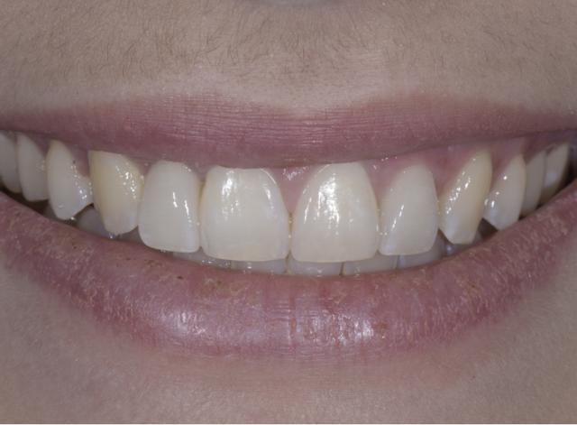 Dental Crowns after at Luminous Smiles in Newport Beach, CA