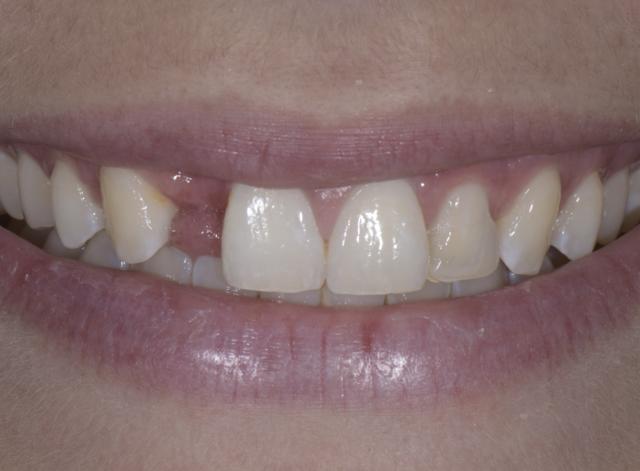 Dental Crowns before at Luminous Smiles in Newport Beach, CA