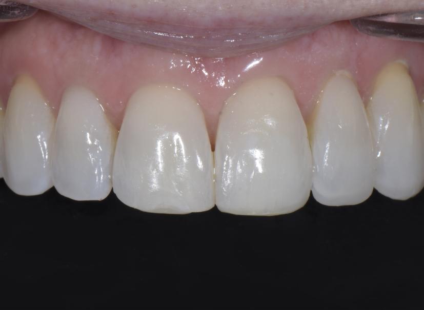 Luminous Smiles dental bonding after — Newport Beach, CA