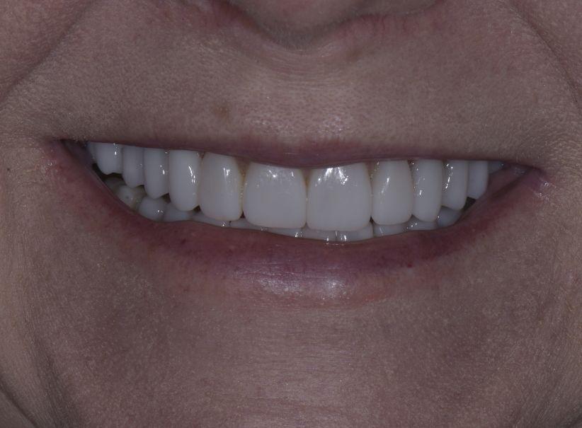 Luminous Smiles smile makeover after — Newport Beach, CA