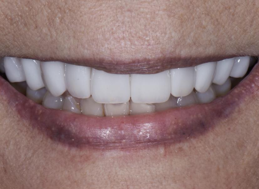 Luminous Smiles veneers after — Newport Beach, CA