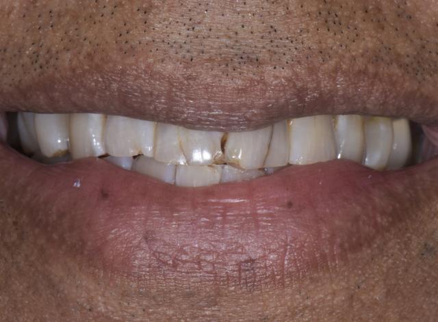 Teeth Whitening before at Luminous Smiles in Newport Beach, CA