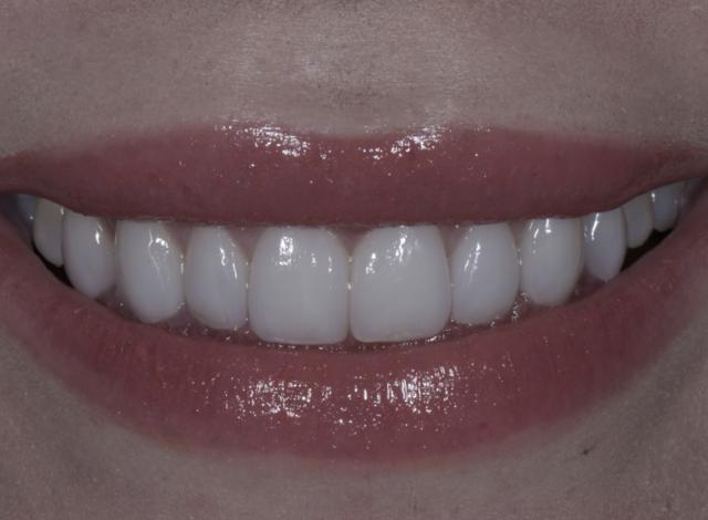Smile Makeover after at Luminous Smiles in Newport Beach, CA