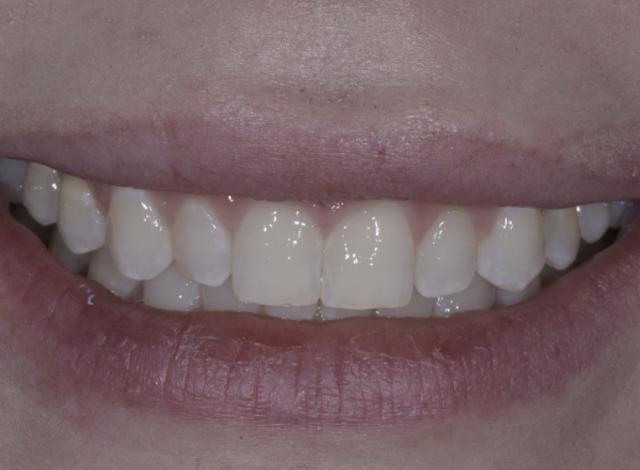 Smile Makeover before at Luminous Smiles in Newport Beach, CA