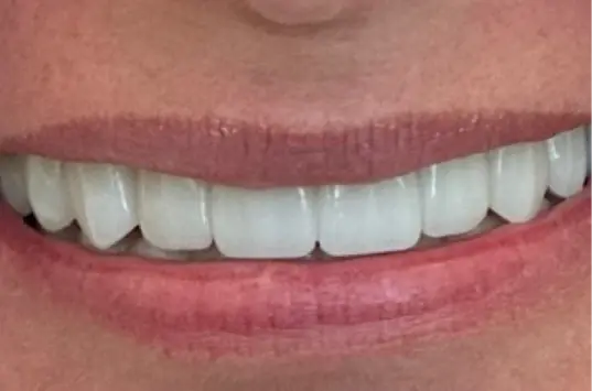The Crown Dental Arts smile makeover after — Draper, UT