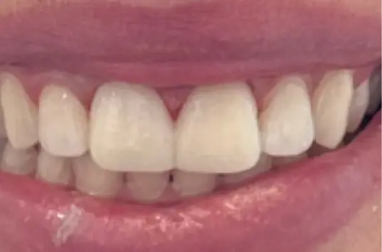 The Crown Dental Arts veneers after — Draper, UT