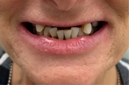 Smile Makeover before at The Crown Dental Arts in Draper, UT