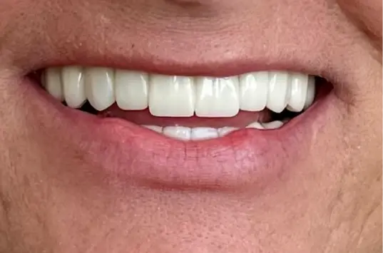 Smile Makeover after at The Crown Dental Arts in Draper, UT