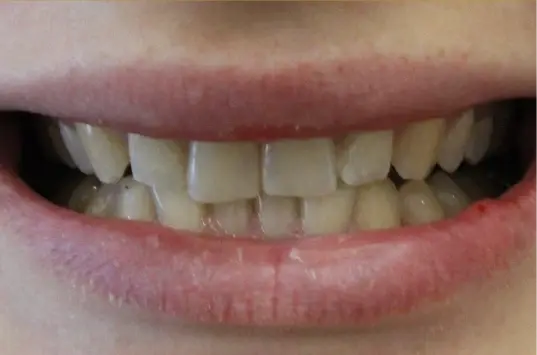The Crown Dental Arts invisalign after — Draper, UT