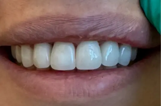 The Crown Dental Arts veneers after — Draper, UT