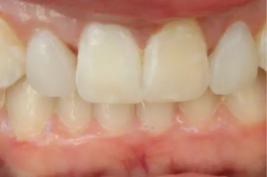 The Crown Dental Arts dental bonding after — Draper, UT