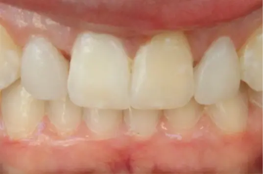 The Crown Dental Arts dental bonding after — Draper, UT