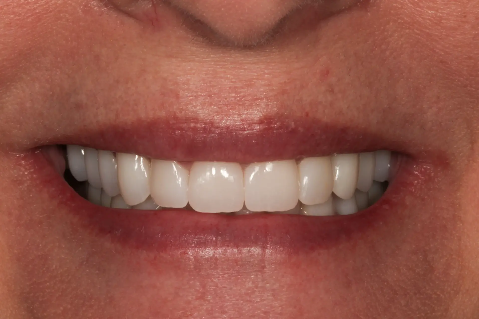 The Crown Dental Arts veneers after — Draper, UT