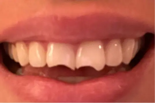 Dental Veneers before at The Crown Dental Arts in Draper, UT