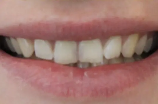 Invisalign before at The Crown Dental Arts in Draper, UT