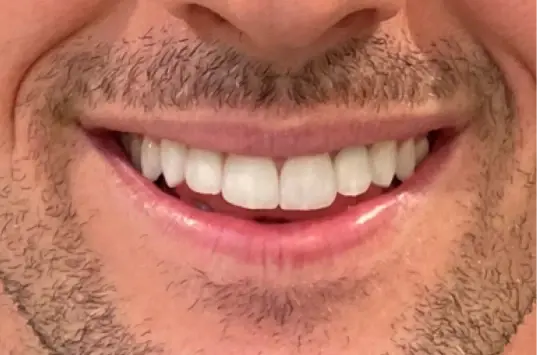 The Crown Dental Arts veneers after — Draper, UT
