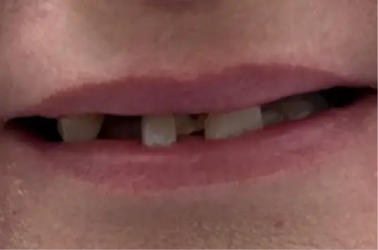 Smile Makeover before at The Crown Dental Arts in Draper, UT